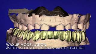 Ästhetische Aufbissschienen für Sie modelliert