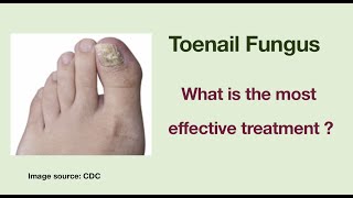 The most effective and inexpensive treatment for toenail fungus