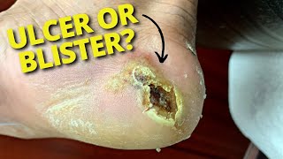 (SUPER SATISFYING!) Different Ways To Care For An Ulcer Or Blister!