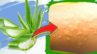 Urticaria or Hives - 7 Home Remedies for Hives