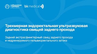 Задний экстрасфинктерный свищ заднего прохода и недренируемого пельвиоректального затека