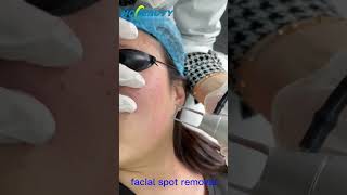 laser technology for facial pigment spot removal