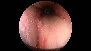 Stratos - Endoscopic Cubital Tunnel Release