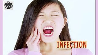 Wisdom Teeth Infection Symptoms After Removal | Wisdom Teeth