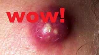 Давить прыщи Dermatologist video to press pimples Черные точки, поры 粉刺 粟粒