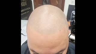 SCALP MICROPIGMENTATION  / ANTONIO BAROQUE