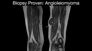 Biopsy Proven Angioleiomyoma