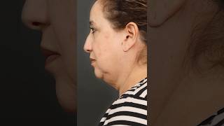 Face & Neck Lift💫 Dr. Sadri Ozan Sozer