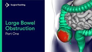 Large Bowel Obstruction Part 1| What is it and How Common is it?