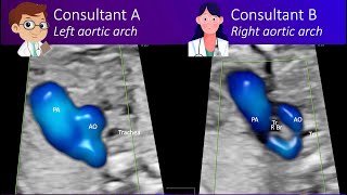 Answer to puzzle between right sided or left sided aortic arch