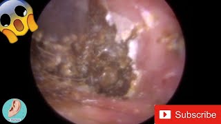 Double Impacted Ear Wax Plug removed