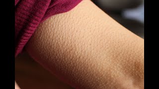 Why Don't Goose Bumps Appear On Our Face?