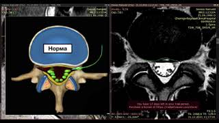 Грыжа 1 см и стеноз канала. Диагностика боли в спине