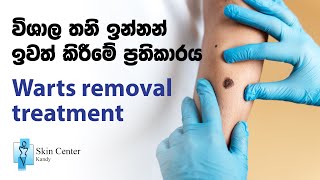 Warts removal treatment /  විශාල තනි ඉන්නන් ඉවත් කිරීමේ ප්‍රතිකාරය