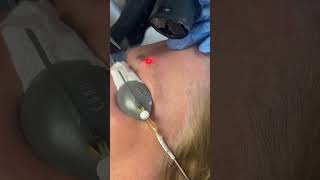 Laser eyebrow tattoo removal, removing eyebrow tattoo #lasertattooremoval #eyebrowtattoo