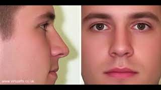 attractive straight nose (blueprint formula)