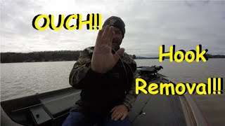 OUCH !!!! How to remove a fishing hook by yourself!