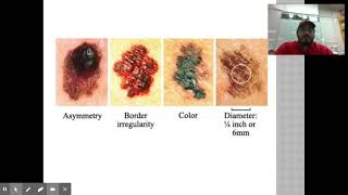 Integumentary System Disorders- Cancer, Burns, and Others!