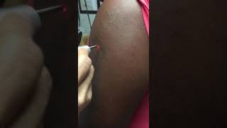 Laser tattoo removal on arm tattoo on darker skin