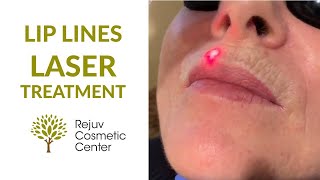 Lip Lines Sciton LaserTreatment- Rejuv Cosmetic Center NJ