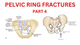 PELVIC RING FRACTURES  - PART  - 4, EPISODE 4