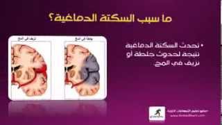 cerebrovascular stroke - السكتة الدماغية