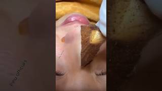 Remove Blackheads & Whiteheads Permanently At Home | Get Rid Of Blackheads #shorts #viralvideo #diy