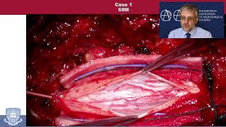 2021 - EANS COURSE VALENCIA -  SPINAL CAVERNOMA - HOW I DO IT