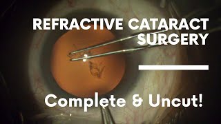 Refractive Cataract Surgery (Complete and Uncut) in 2020