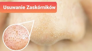 5 naturalnych sposobów na usunięcie zaskórników