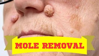 Mole Removal Journey