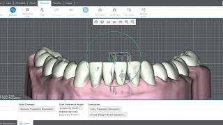 In office aligners- no audio