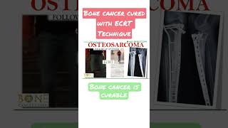 #ECRT तकनीक से हड्डी के कैन्सर का इलाज BoneCancer cured with #ECRT Technique #Osteosarcoma