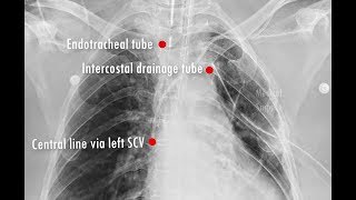 Chest X-ray: Tubes/ Catheters