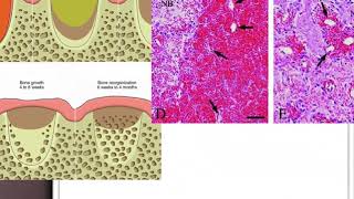 Extraction socket healing and Dry socket