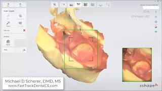 3Shape TRIOS Post & Core PVS Hybrid Scanning Technique