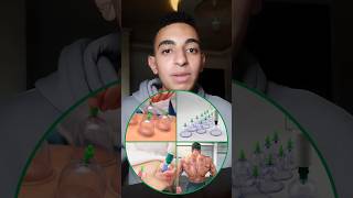 الحجامة وفوائدها |Cupping therapy