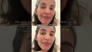 El botox es una ilusión a corto plazo #botox #estetica