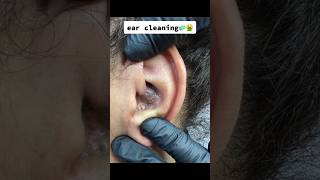 Blackheads In Ear