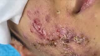 Büyük Kistik Akne ve Siyah Noktaların temizlenmesi .Big Cystic Acne Blackheads Extraction