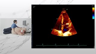 〖Echocardiography〗 Apical 4-ChV - hands-on 💫 💟