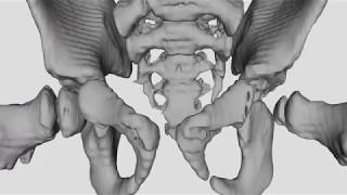 3D model from CT reconstraction  Developmental  Hip dyplasia