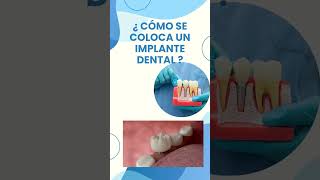 ¿CÓMO SE COLOCA UN IMPLANTE DENTAL?