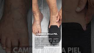 Síntomas más comunes de las varices