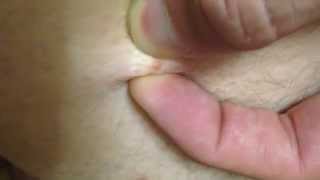 White zit with black head on ass прыщик на жопе