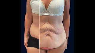 Avant après bodylift #chirurgieesthetique #chirurgieplastique #chirurgienesthetique