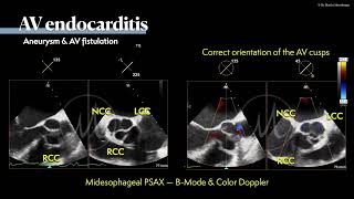 〖Echocardiography〗 Aneurysm formation & endocarditis 😱