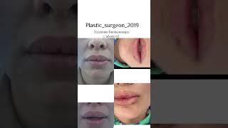 Удаление биополимера с обеих губ @plastic_surgeon_2019