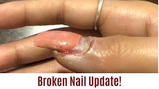 BROKEN NAIL UPDATE.. DID IT GROW BACK? + STARBUCKS MUKBANG😋