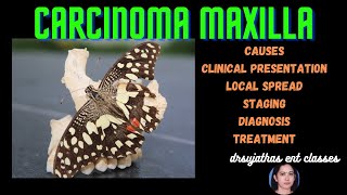 148.Carcinoma Maxilla  #Carcinoma maxillary sinus #clinicalexamination #surgeryeducation